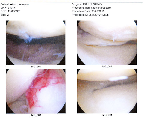 Houston we have a problem !

Today has presented a challenge for the project.  Not only today, but for the next few weeks.

I spent today in hospital having surgery on my my right knee.  I have managed to tear the cartilage and it required surgery to fix it.

So today we have a self-portrait.....  I didn't take the photo but I am the subject, well my knee is!

Not for the squeamish, but these are  the shots of my op.